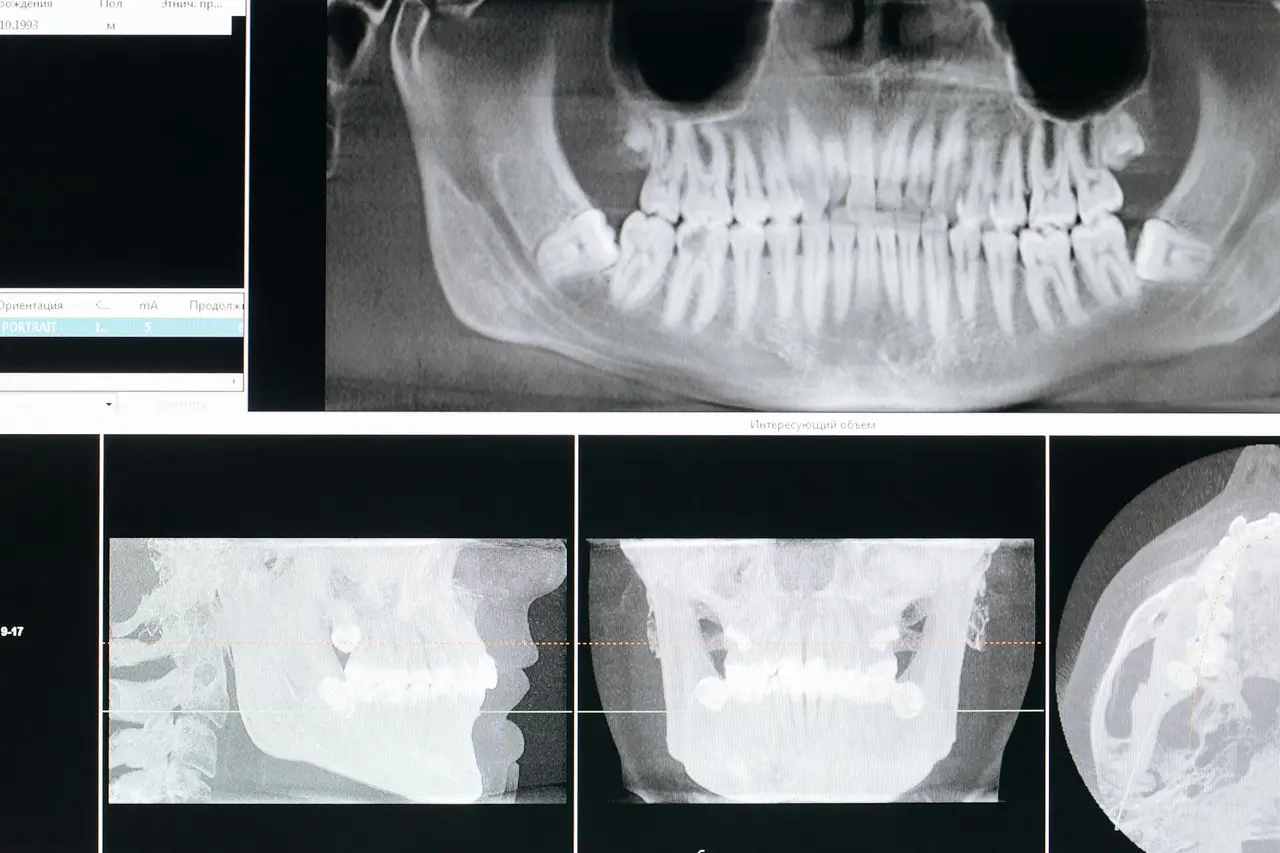 Quanto tempo dura um implante dentário e o que influencia na longevidade